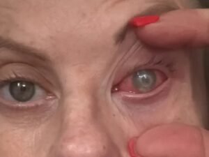 Una mujer podría perder la visión por una rara infección ocular: “Se va comiendo el ojo, la córnea y todos los nervios”