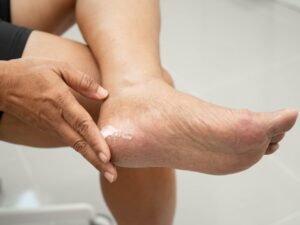 “La diabetes es una de las enfermedades que más se manifiesta en la piel”: a qué estar atentos